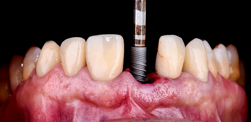 inserting the dental implant - obrazy, fototapety, plakaty