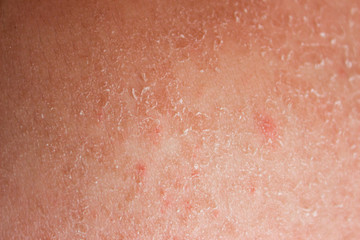 Dry skin. Skin is sunburn, Peeling skin at back from sunburn effect on body at summer, dangerous sunburn concept.
