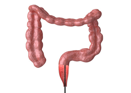 colonoscopy - is the endoscopic examination of the large intestine and rectum that helps in the discovery of bowel cancer