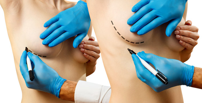 Collage. Plastic surgery for female breast correction.