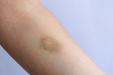 Fototapeta premium people with bruised arm closeup