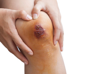 Fresh wound on asian female knee