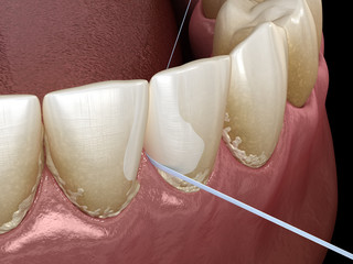 Oral hygiene: using dental floss for plaque removing. Medically accurate dental 3D illustration