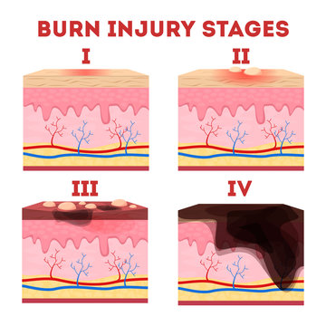 Skin burn injury stages. Anatomy of the skin.