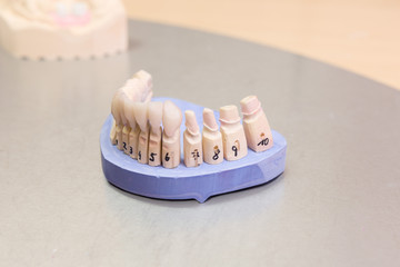 Dental imprint with artificial dentition in a dental laboratory