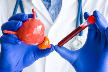 Laboratory medical diagnostics, tests and hormones for bladder and prostate  concept photo. Doctor...