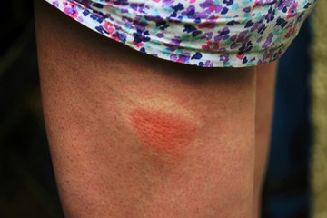   Painful allergic reaction caused by an insect bite  