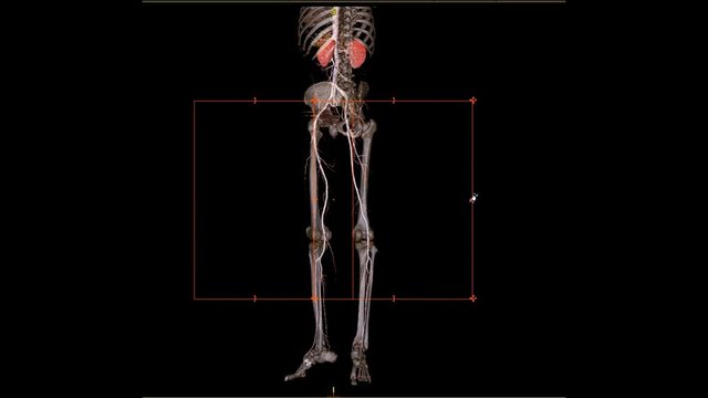 CTA femoral artery run off  3D rendering image of femoral artery with kidney for Patients Presenting with Acute or Chronic Peripheral Arterial Disease.
