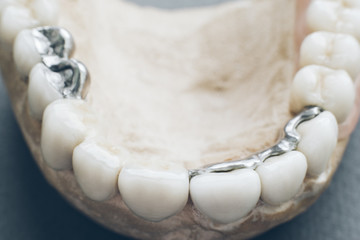 Dental implantation and stomatology. Gypsum jaw with ceramic dentures and metal prosthesis.