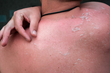 peeling skin at back and shoulder from sunburn effect on body of young man from sunbath at summer. dangerous sunburn concept 