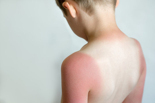 Strong tan in the boy. Red hands and back. Sore skin, blistered. No sun protection