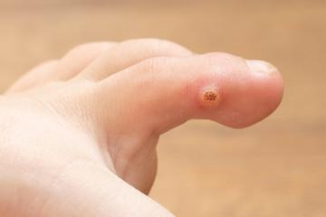 Closeup of foot with an infected wart placed on toe. Foot wart. Foot bottom pathology: verruca,...