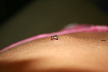 Birthmark on the skin Papiloma on the body