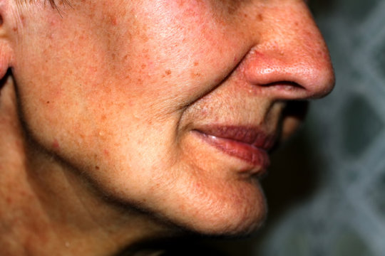 Sunken Cheeks. Nasolabial Folds On Face. Wrinkles.