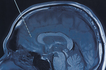 Depth electrode on brain MRI imaging.