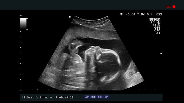 Baby is moving in mother's belly during ultrasound procedure, modern ultrasonography is showing the baby in the womb on the medical monitor