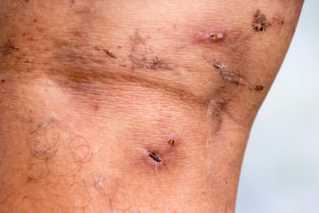 Fototapeta premium close up picture of scar on the back knee