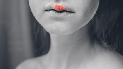 Herpes on the Upper Lip of a Young Woman