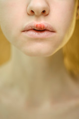 Fototapeta premium Herpes on the Upper Lip of a Young Woman