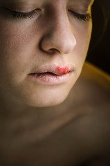 Herpes on the Upper Lip of a Young Woman