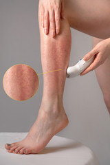 A young woman removes excess hair with a depilator. Concept of home skin care and Spa. Redness and...