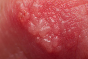 Beginning of growing herpes on caucasian male man on front upper lip super macro microscope