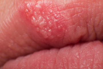 Beginning of growing herpes on caucasian male man on front upper lip super macro microscope