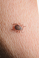 Forest mite on the skin. wood tick