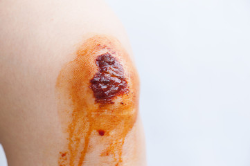 Scar and scab (eschar) on the knee