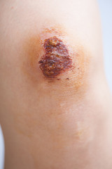 Fototapeta premium Scar and scab (eschar) on asian female knee