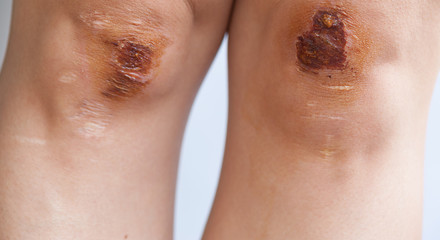 bike injury wound on asian female knees