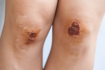 bike injury wound on asian female knees