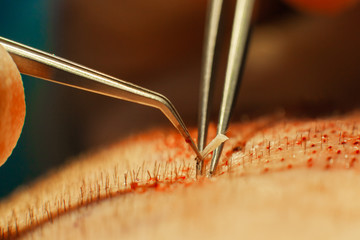 Macrophotography of a hair bulb transplanted into a hairless area. Baldness treatment. Hair...