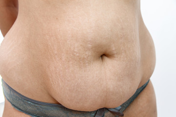 big belly with stretch marks of a young overweighted woman .