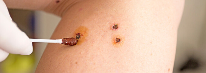 Skin scars from laser removal of moles.