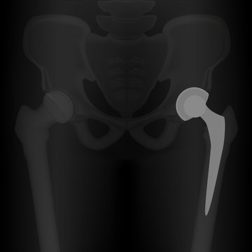 Vector Illustration. X-ray Of Human Total Hip Replacement. For Advertisement And Medical Publications.