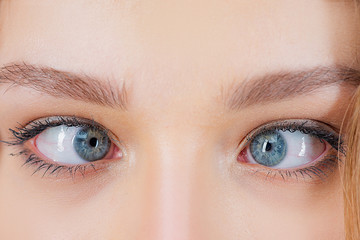 Strabismus Eye Surgery. Close up of crazy female eyes with squint. Eye muscle recession....