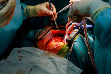 Surgery doctor in surgery center for open heart surgery - obrazy, fototapety, plakaty