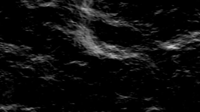 Footage of Ultrasonography inside. Black and white