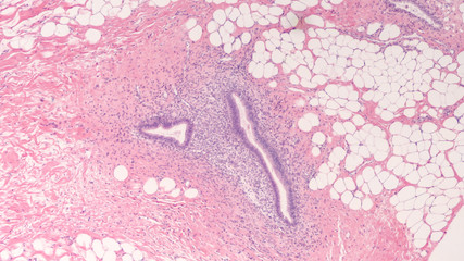 Microscopic image of endometriosis, a condition in which endometrial glands and stroma occur in locations other the the endometrium of the uterus, in this case in subcutaneous abdominal tissue. 