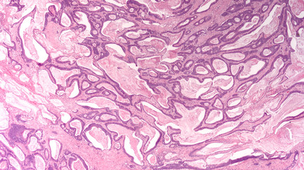 Colon Cancer: Photomicrograph (microscopic image) of an invasive colonic adenocarcinoma. Screening...