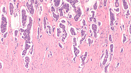 Photomicrograph of a neuroendocrine tumor (NET, aka carcinoid) of small intestine (ileum), with...