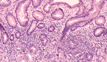 Microscopic image of an endoscopic gastric (stomach) biopsy showing chronic active gastritis (inflammation) due to Helicobacter pylori, a type of bacterial infectio