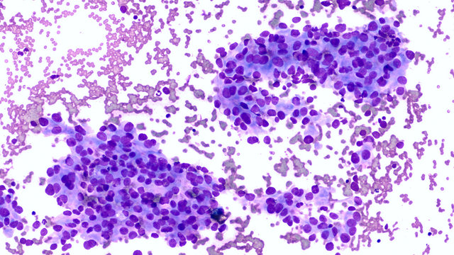 Microscopic image showing cancer cells (cytology) of adenocarcinoma of lung, obtained by cat scan (CT) guided fine needle aspiration (FNA), as part of a pulmonary nodule screening program.  