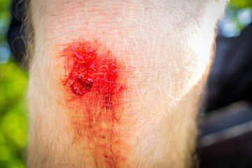 Fototapeta premium Emergency accident open abrasion wound trauma skin leg knee. People, healthcare and medicine concept