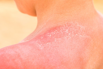 A close up childs shoulder with red sun burnt peeling off skin. Summer UV protection, health and safe vacation concept