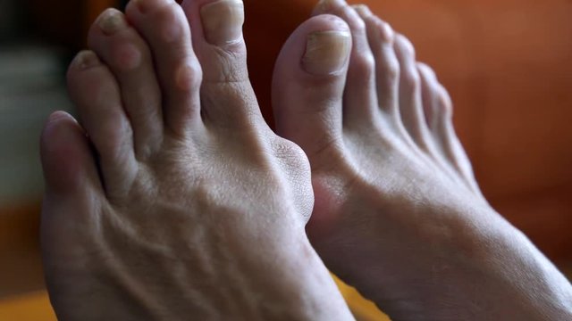 woman's foot with bunion