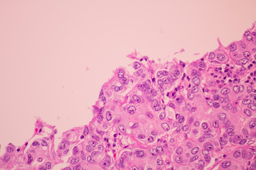 View in microscopic of pathology cross section tissue ductal cell carcinoma or adenocarcinoma diagnosis by pathologist in laboratory.H and E stain.Criteria of breast cancer.Medical concept