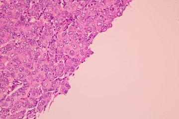 Section tissue of breast cancer view in microscopy.Ductal cell carcinoma.Criteria of glandular...