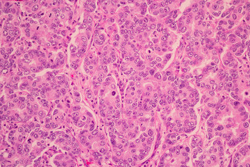 Section tissue of breast cancer view in microscopy.Ductal cell carcinoma.Criteria of glandular...